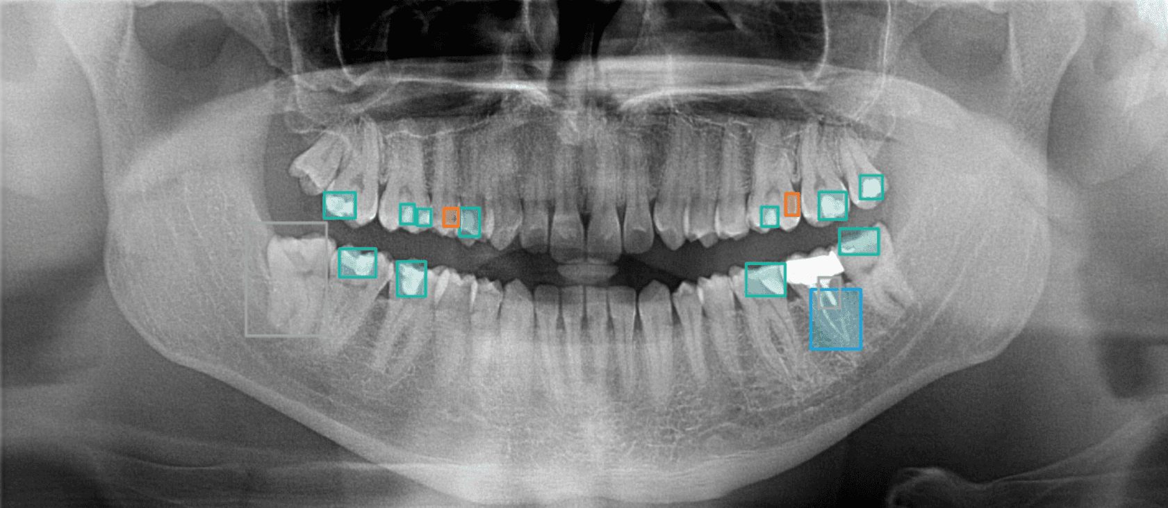 Cavitech imaging and treatment workflow