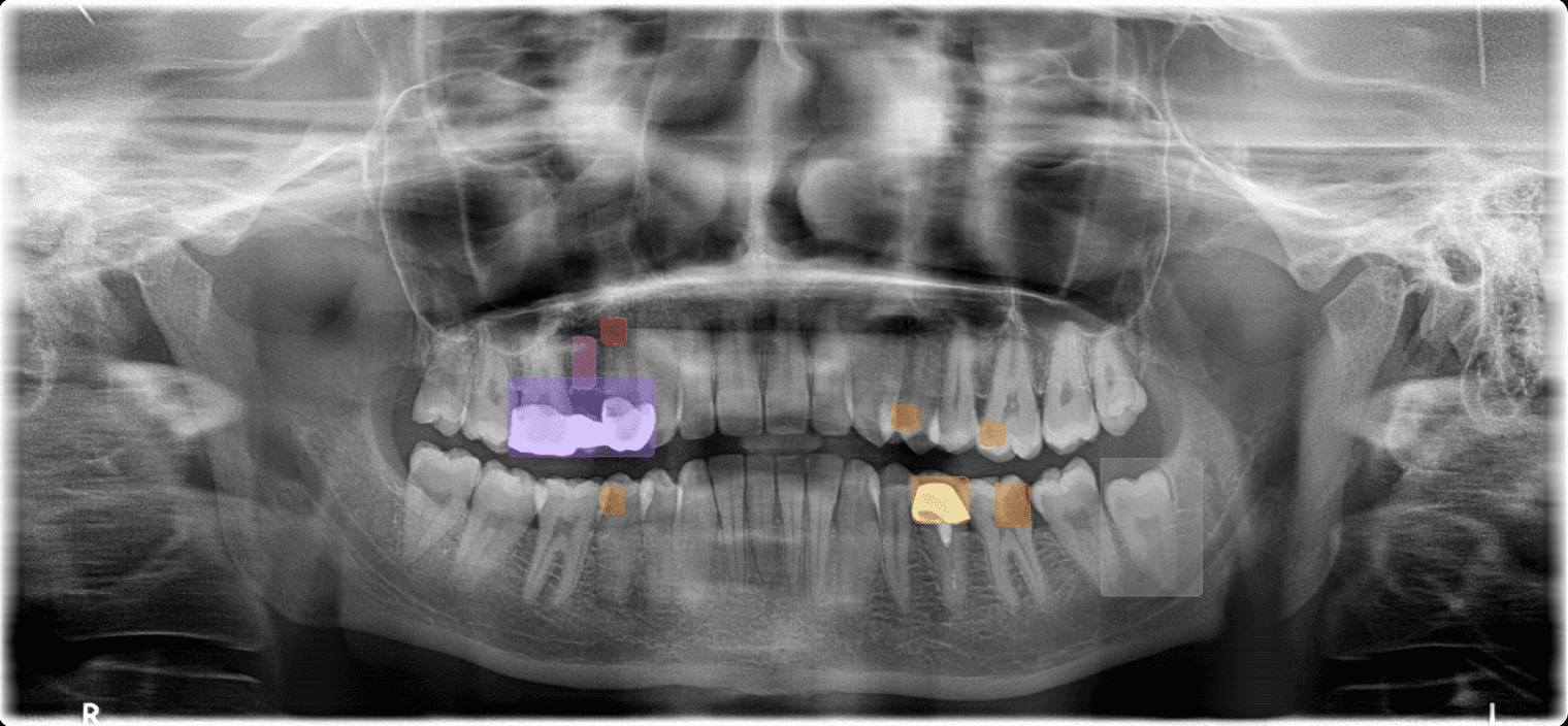 Dental panoramic X-ray with AI pathology and anatomy overlays