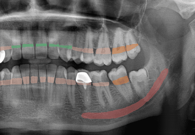 Dental radiograph showing AI bone segmentation