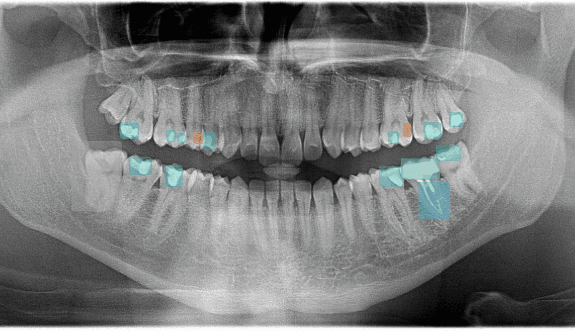 Annotated dental radiograph showing candidate observations